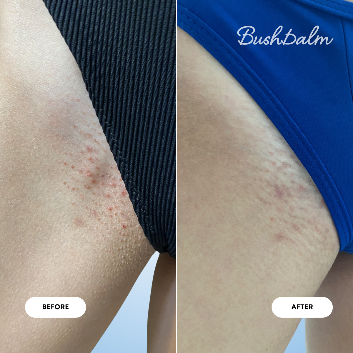 2-Step Ingrown Hair Routine - Nude D3