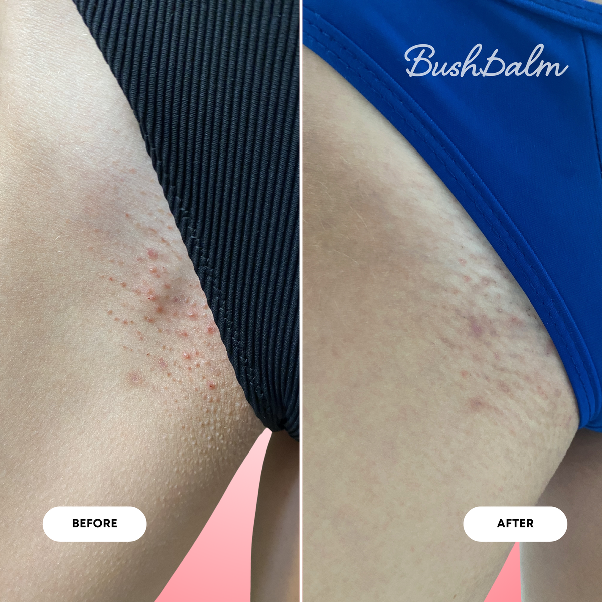 2-Step Ingrown Hair Routine - Watermelon Sugar Z8